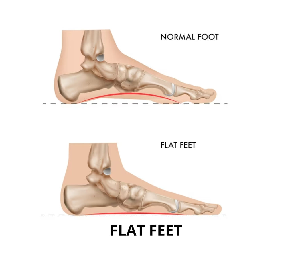 The Ultimate Guide to Finding the Perfect Shoes for Flat Feet (Pes Pla ...